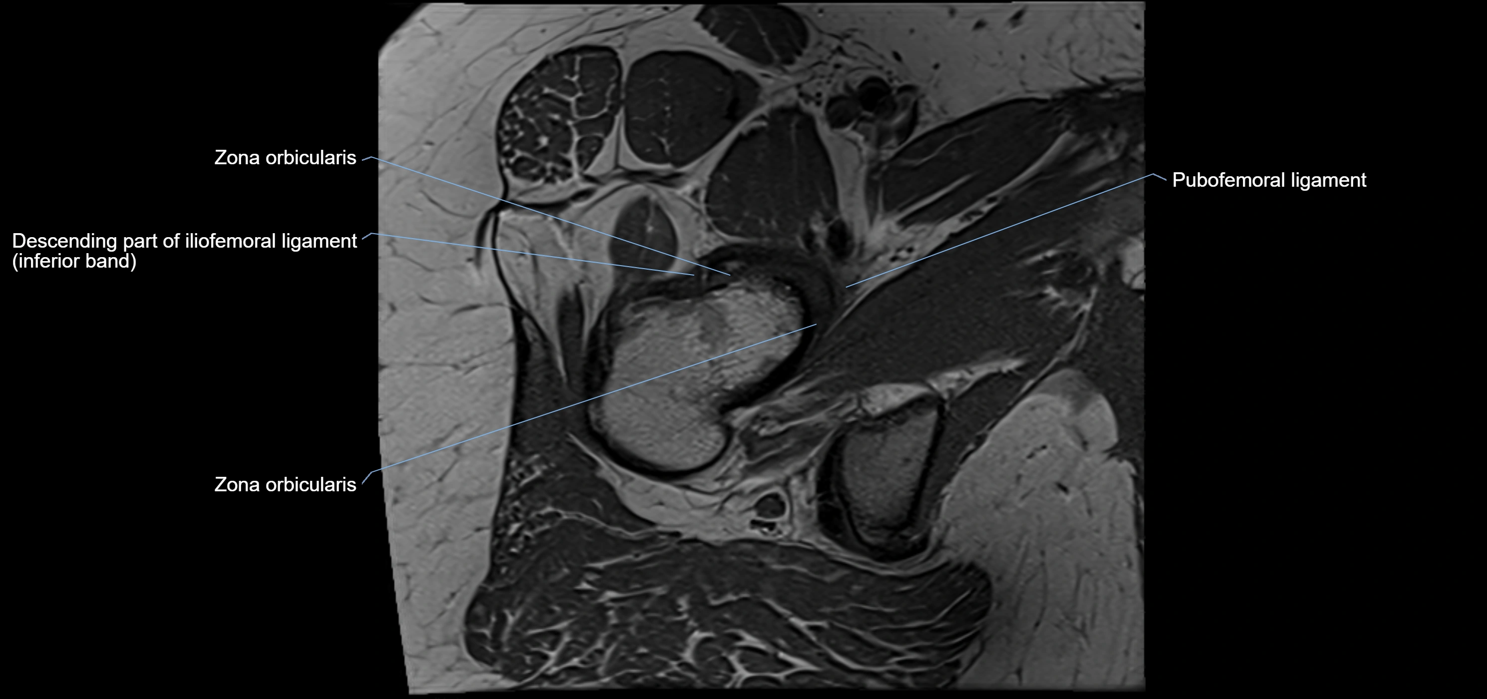 Hip ligament anatomy axial 3T MRI image -img-13001-00023.webp